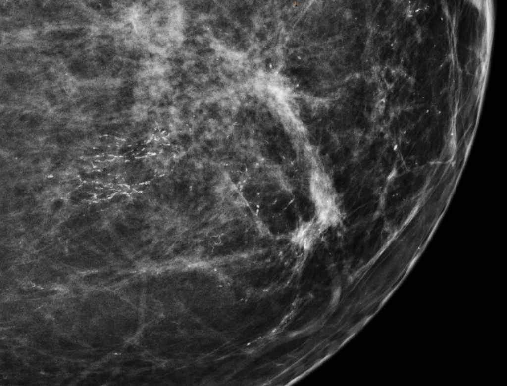 Magnified mammographic image showing clustered irregular linear and branching microcalcifications within breast tissue.
