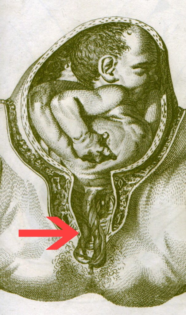 Obstetric illustration showing the umbilical cord descending through the cervix below the fetal presenting part.