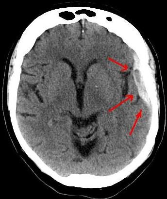Axial noncontrast head CT showing a crescentic extra-axial collection along the left cerebral convexity with local mass effect.