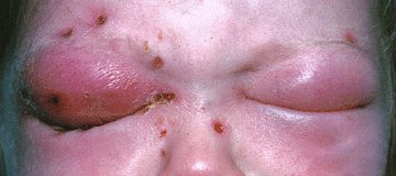 Clinical photograph showing marked unilateral eyelid swelling, conjunctival edema, and forward displacement of the eye.