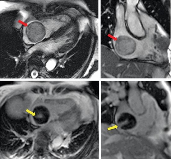 Cardiac MRI montage demonstrating a rounded left atrial soft-tissue mass attached near the interatrial septum with heterogeneous enhancement.