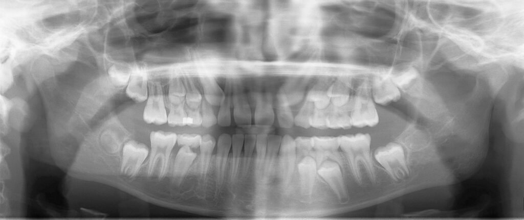 Panoramic radiograph of a child showing erupted permanent teeth, retained primary teeth, and multiple developing unerupted permanent successors.