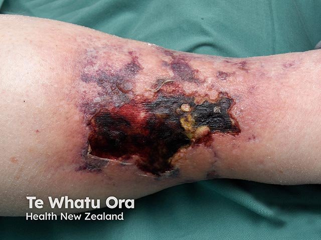 Clinical photograph showing irregular purpuric change with necrosis and ulceration on the lower limb.