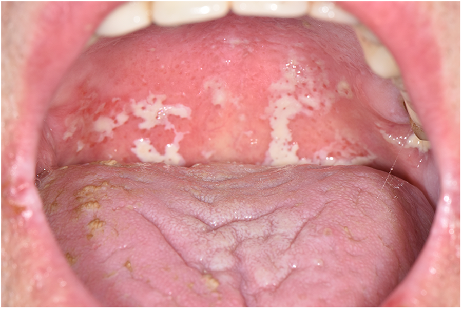 Intraoral photograph showing irregular white pseudomembranous plaques involving the posterior oral cavity.