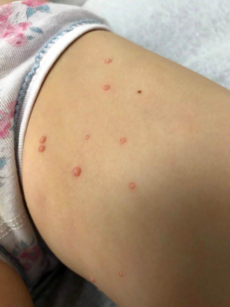 Clinical photograph showing multiple small smooth papules on the thigh with visible central surface depressions.