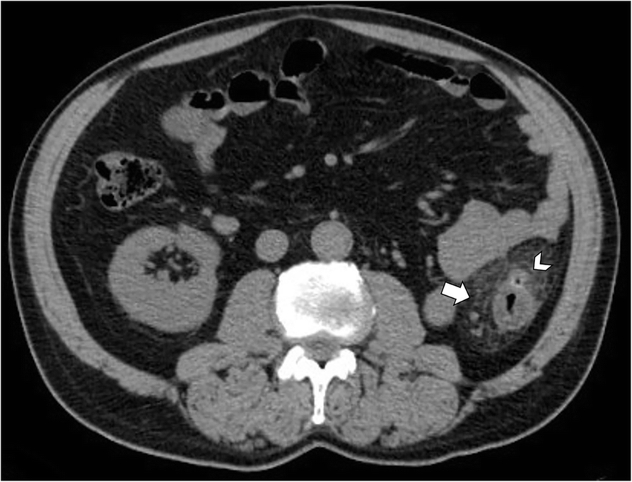 Axial abdominal CT showing a small pericolonic fat-density ovoid lesion with a thin dense rim and surrounding stranding.