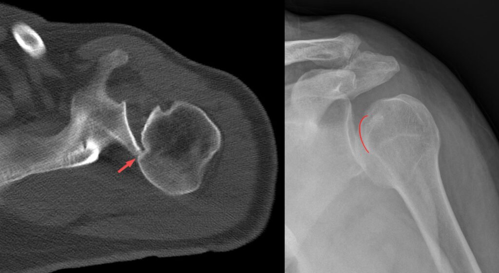 Axial shoulder CT and radiograph showing posterior humeral-head displacement with an anteromedial impaction defect.