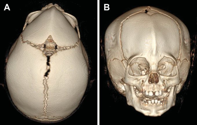Superior and frontal three-dimensional skull reconstructions showing a triangular forehead, fused metopic suture, narrowed frontal vault, and closely spaced orbits.