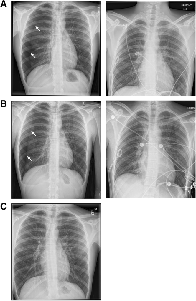 Chest radiograph showing a large right pneumothorax with marked lung collapse and mediastinal displacement.