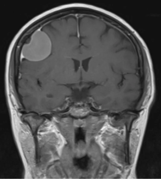 Coronal postcontrast brain MRI demonstrating a uniformly enhancing dural-based convexity mass with adjacent enhancing dura.