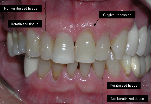 Frontal intraoral photograph demonstrating keratinized and nonkeratinized gingival tissues with a localized area of gingival recession.