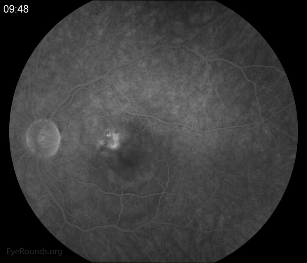Late fluorescein angiogram showing focal progressive leakage in the macular region.