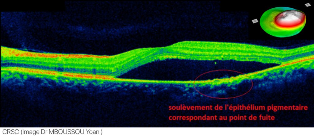 Macular OCT showing a broad neurosensory retinal elevation with optically clear subretinal fluid.