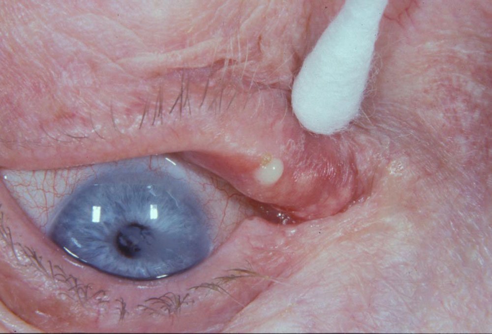 Clinical photograph showing focal swelling at the upper lacrimal punctum with visible purulent material.