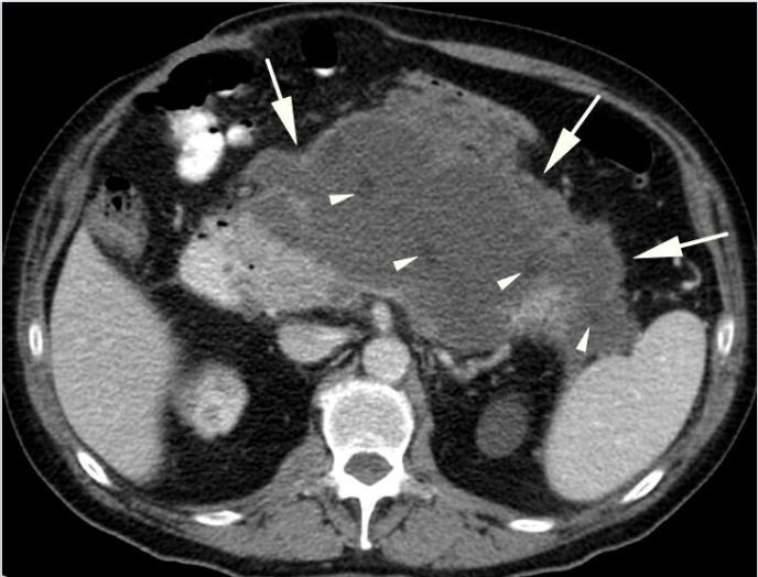 Axial contrast-enhanced CT showing an enlarged pancreas with extensive heterogeneous nonenhancing parenchymal regions and surrounding collections.