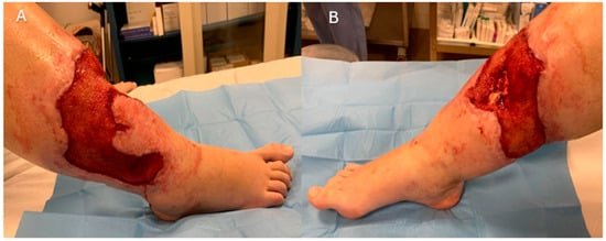 Medial and lateral clinical photographs showing a circumferential distal-leg wound after debridement, with extensive soft-tissue loss and exposed tibia.