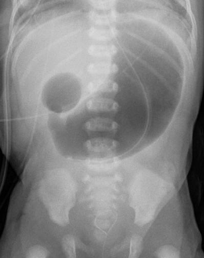 Neonatal abdominal radiograph showing two prominent upper-abdominal gas-filled structures with no visible distal intestinal gas.