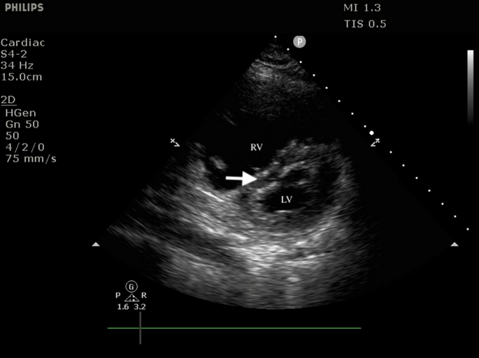 Parasternal short-axis echocardiographic view showing a markedly enlarged right ventricle and interventricular septal flattening with a relatively small left ventricle.