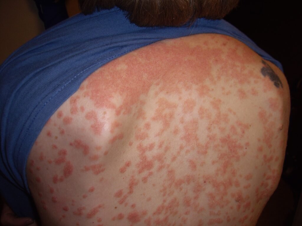 Numerous small erythematous scaly papules and plaques are scattered widely across the upper trunk and back. Вікісховище