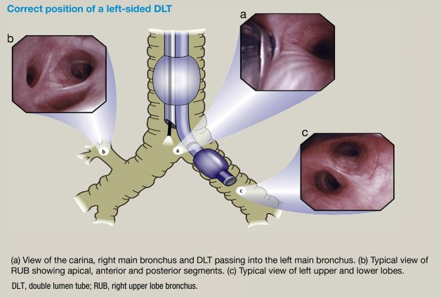 Diagram with bronchoscopic views demonstrating a left-sided double-lumen tube seated in the left main bronchus with appropriate visualization of bronchial anatomy.