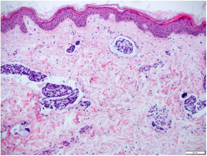 H&E section of skin containing multiple coiled eccrine sweat-gland structures and their ducts within the dermis.