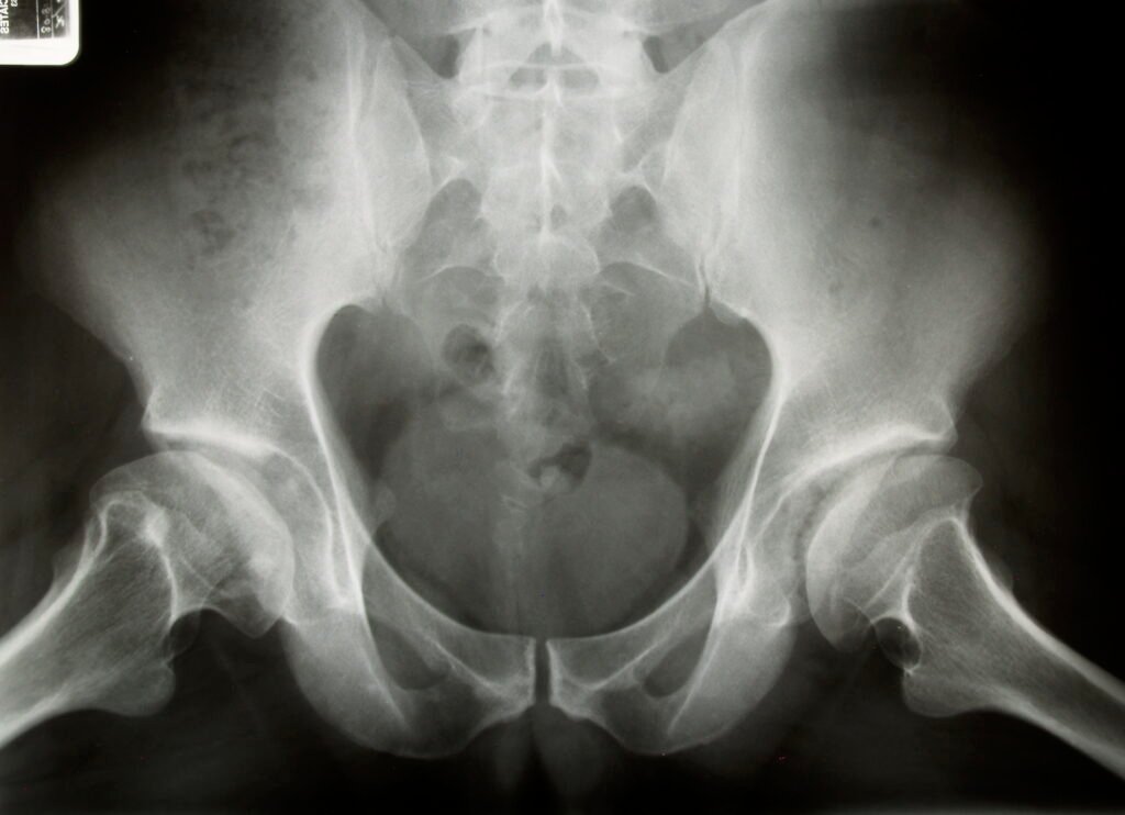 Pelvic radiograph showing flattening, sclerosis, and fragmentation affecting the femoral heads.
