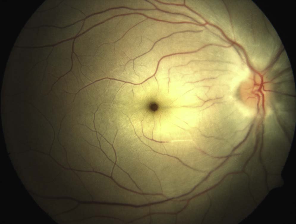 Color fundus photograph showing diffuse inner retinal whitening with a contrasting foveal appearance.