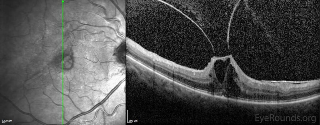 OCT showing persistent posterior hyaloid attachment producing focal foveal elevation, distortion, and intraretinal cystic change.