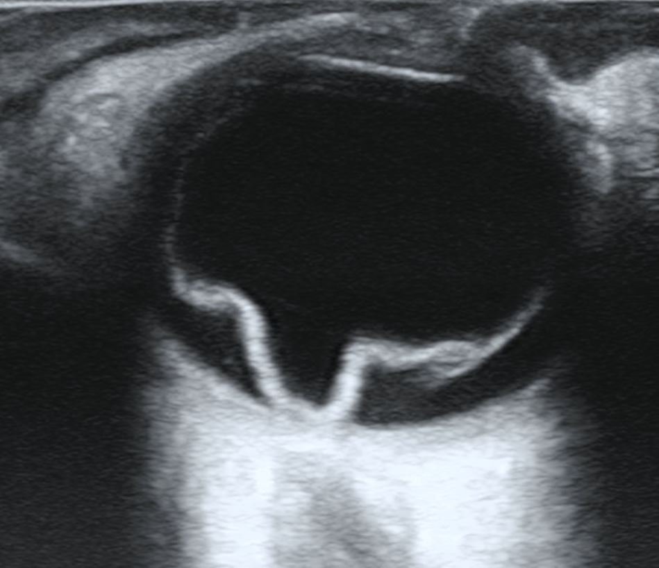Ocular ultrasound showing an echogenic folded membrane separated from the posterior wall of the globe.