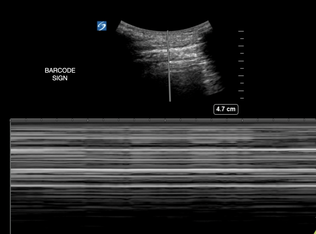 Lung ultrasound M-mode image showing parallel horizontal lines above and below the pleural line, producing a barcode or stratosphere pattern.