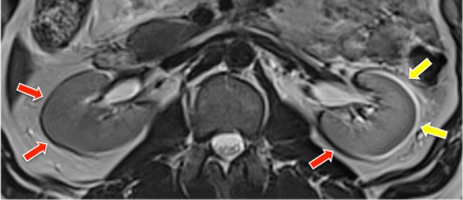 MRI demonstrates paired bright and dark bands at interfaces between fat and water-containing tissues.