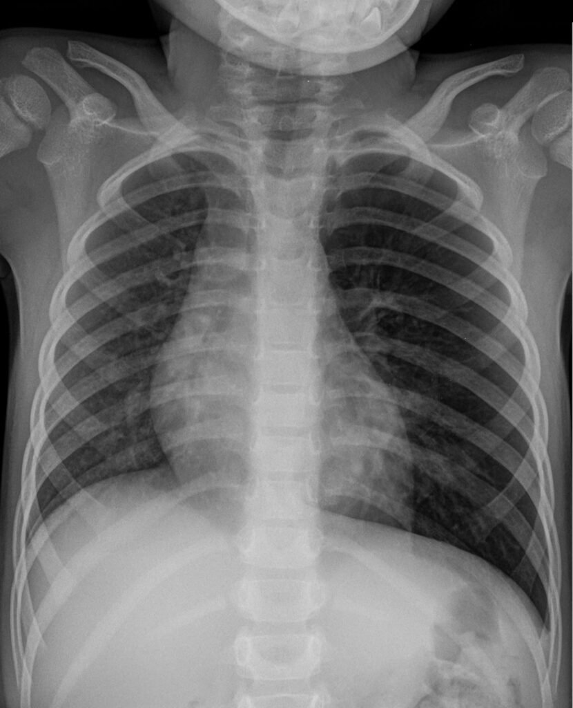 Pediatric chest radiograph showing marked unilateral left-lung hyperinflation with mediastinal displacement following peanut aspiration.